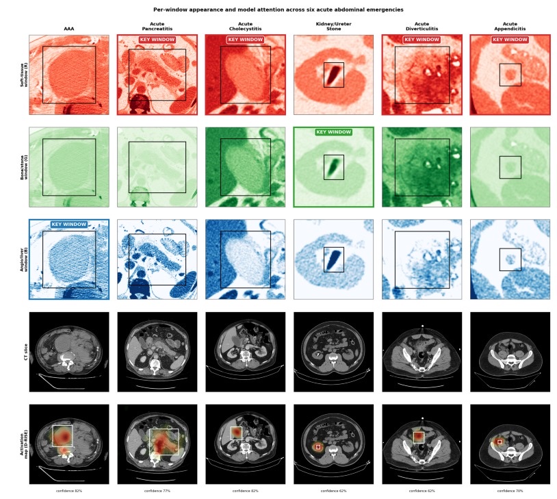 Figure from the Atlas paper: per-window CT appearance (soft tissue, bone/stone, angio/liver) alongside CT slices and model activation maps across six acute abdominal emergencies
