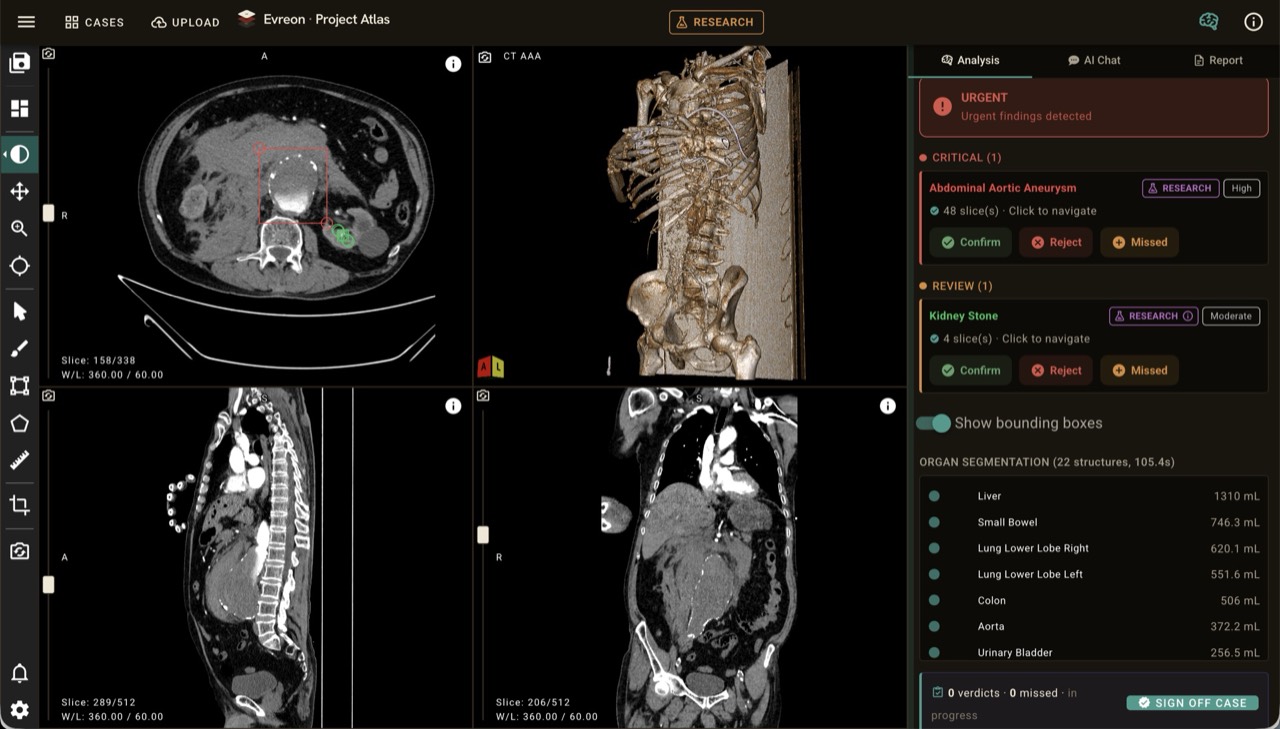 Project Atlas abdominal CT review interface showing a four-panel scan viewer, emergency analysis findings, and clinician review actions