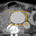 Abdominal Aortic Aneurysm bounding-box exemplar 14