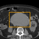 Abdominal Aortic Aneurysm bounding-box exemplar 15