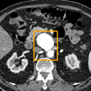 Abdominal Aortic Aneurysm bounding-box exemplar 8
