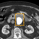 Abdominal Aortic Aneurysm bounding-box exemplar 6