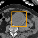 Abdominal Aortic Aneurysm bounding-box exemplar 13