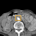 Abdominal Aortic Aneurysm bounding-box exemplar 2