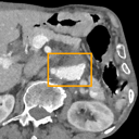 Abdominal Aortic Aneurysm bounding-box exemplar 7