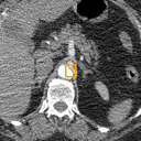 Abdominal Aortic Aneurysm bounding-box exemplar 1