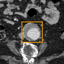 Abdominal Aortic Aneurysm bounding-box exemplar 10