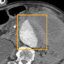 Abdominal Aortic Aneurysm bounding-box exemplar 16