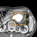 Abdominal Aortic Aneurysm bounding-box exemplar 11