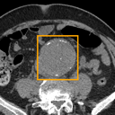 Abdominal Aortic Aneurysm bounding-box exemplar 12