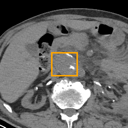 Abdominal Aortic Aneurysm bounding-box exemplar 3