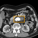 Abdominal Aortic Aneurysm bounding-box exemplar 4