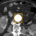 Abdominal Aortic Aneurysm bounding-box exemplar 5