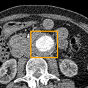 Abdominal Aortic Aneurysm bounding-box exemplar 9