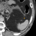 Acute Pancreatitis bounding-box exemplar 1