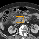 Acute Pancreatitis bounding-box exemplar 3