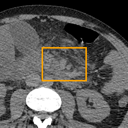Acute Pancreatitis bounding-box exemplar 10