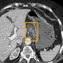 Acute Pancreatitis bounding-box exemplar 7
