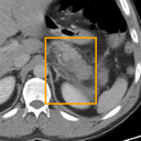 Acute Pancreatitis bounding-box exemplar 14