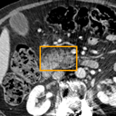 Acute Pancreatitis bounding-box exemplar 8
