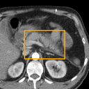 Acute Pancreatitis bounding-box exemplar 13