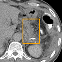 Acute Pancreatitis bounding-box exemplar 11
