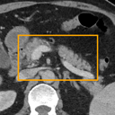 Acute Pancreatitis bounding-box exemplar 16