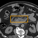 Acute Pancreatitis bounding-box exemplar 9