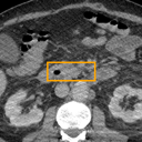 Acute Pancreatitis bounding-box exemplar 5