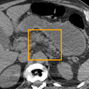 Acute Pancreatitis bounding-box exemplar 12