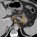 Acute Pancreatitis bounding-box exemplar 4