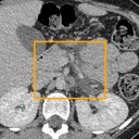Acute Pancreatitis bounding-box exemplar 15