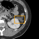 Acute Pancreatitis bounding-box exemplar 6