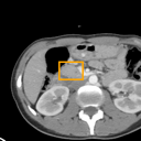 Acute Pancreatitis bounding-box exemplar 2