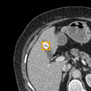 Acute Cholecystitis bounding-box exemplar 3