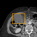 Acute Cholecystitis bounding-box exemplar 14