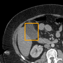 Acute Cholecystitis bounding-box exemplar 11