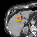 Acute Cholecystitis bounding-box exemplar 4