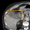 Acute Cholecystitis bounding-box exemplar 16