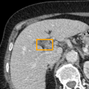 Acute Cholecystitis bounding-box exemplar 6