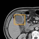 Acute Cholecystitis bounding-box exemplar 12