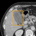 Acute Cholecystitis bounding-box exemplar 15