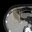 Acute Cholecystitis bounding-box exemplar 13