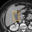 Acute Cholecystitis bounding-box exemplar 10