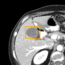 Acute Cholecystitis bounding-box exemplar 9