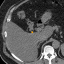 Acute Cholecystitis bounding-box exemplar 1