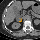 Acute Cholecystitis bounding-box exemplar 2