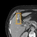 Acute Cholecystitis bounding-box exemplar 8