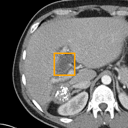 Acute Cholecystitis bounding-box exemplar 7
