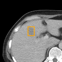 Acute Cholecystitis bounding-box exemplar 5